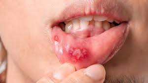 Canker Sore - Everything you need to know