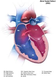 Atrial Septal Defect (ASD) – Everything you need to know