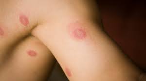 3 Day Ringworm Treatment - Everything you need to know