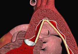 Aortic Dissection - Everything you need to know