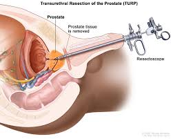 Prostate Cancer Treatment – Everything you need to know