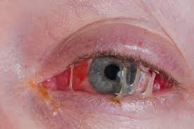 Eye Infection Treatment - Everything you need to know