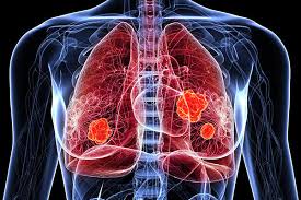 Small Cell Lung Cancer (SCLC) – Everything you need to know