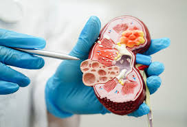 Chronic Kidney Disease (CKD) - Everything you need to know