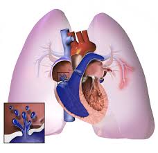 Pulmonary Hypertension – Everything you need to know