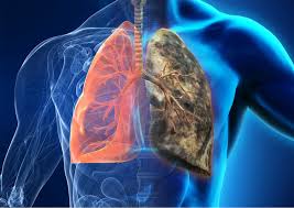 Stage 4 Lung Cancer - Everything you need to know