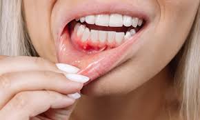 Gum Disease - Everything you need to know