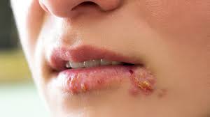 Herpes – Everything you need to know