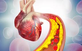 Atherosclerosis – Everything you need to know