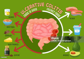 Ulcerative Colitis Diet - Everything you need to know