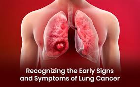 Stage 1 Lung Cancer Symptoms - Everything you need to know