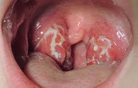 Tonsillitis