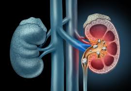 Kidney Stones Causes